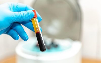 OA Management: 4 Game-Changing Benefits of PRP Therapy