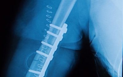 When Does a Rod Help After a Fracture?