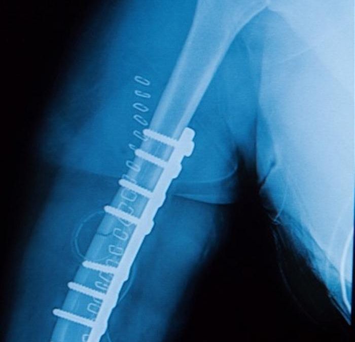 When Does a Rod Help After a Fracture?